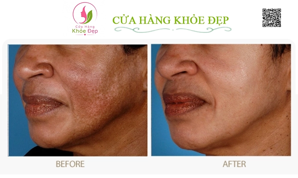 Kem đặc Mờ Nám ZO Melamin Skin Bleaching Crème