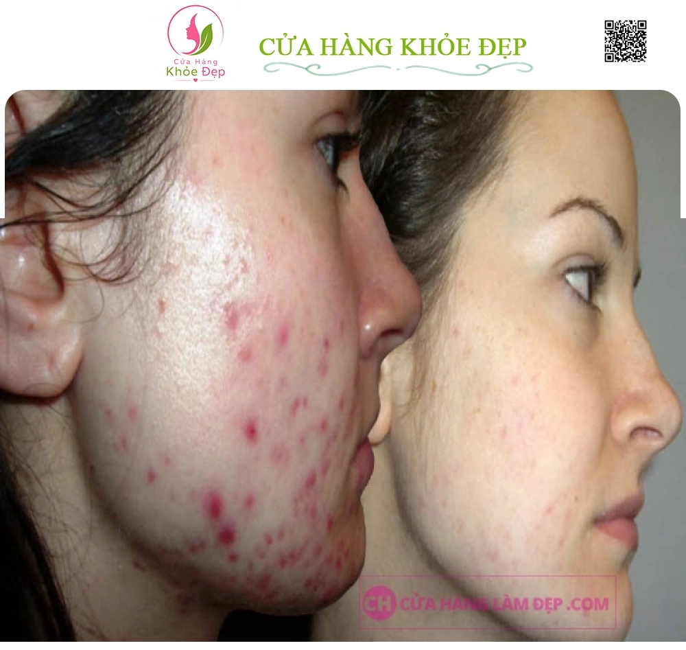 Kem Giảm Mụn, Lão Hoá Da Obagi T.R.E Cream USP 0,025%