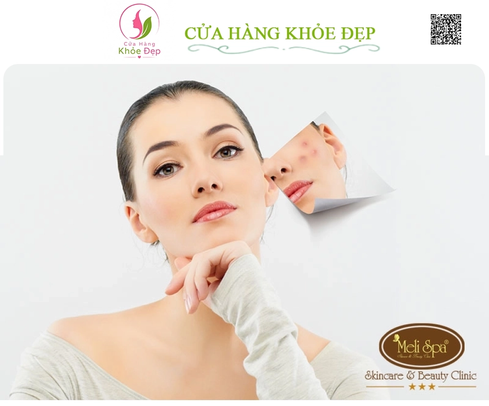 Chăm Sóc Da Mặt Dành Cho Da Nám - Tàn Nhang tại Meli Spa