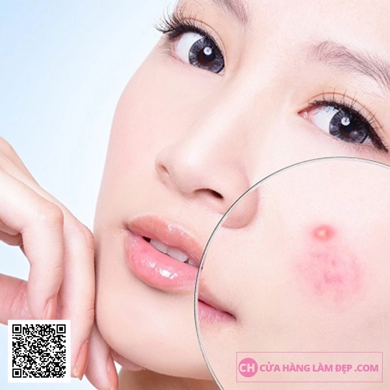 Liệu Trình Điều giảm Mụn Chuyên Sâu Bằng Công Nghệ Cao tại Meli Spa