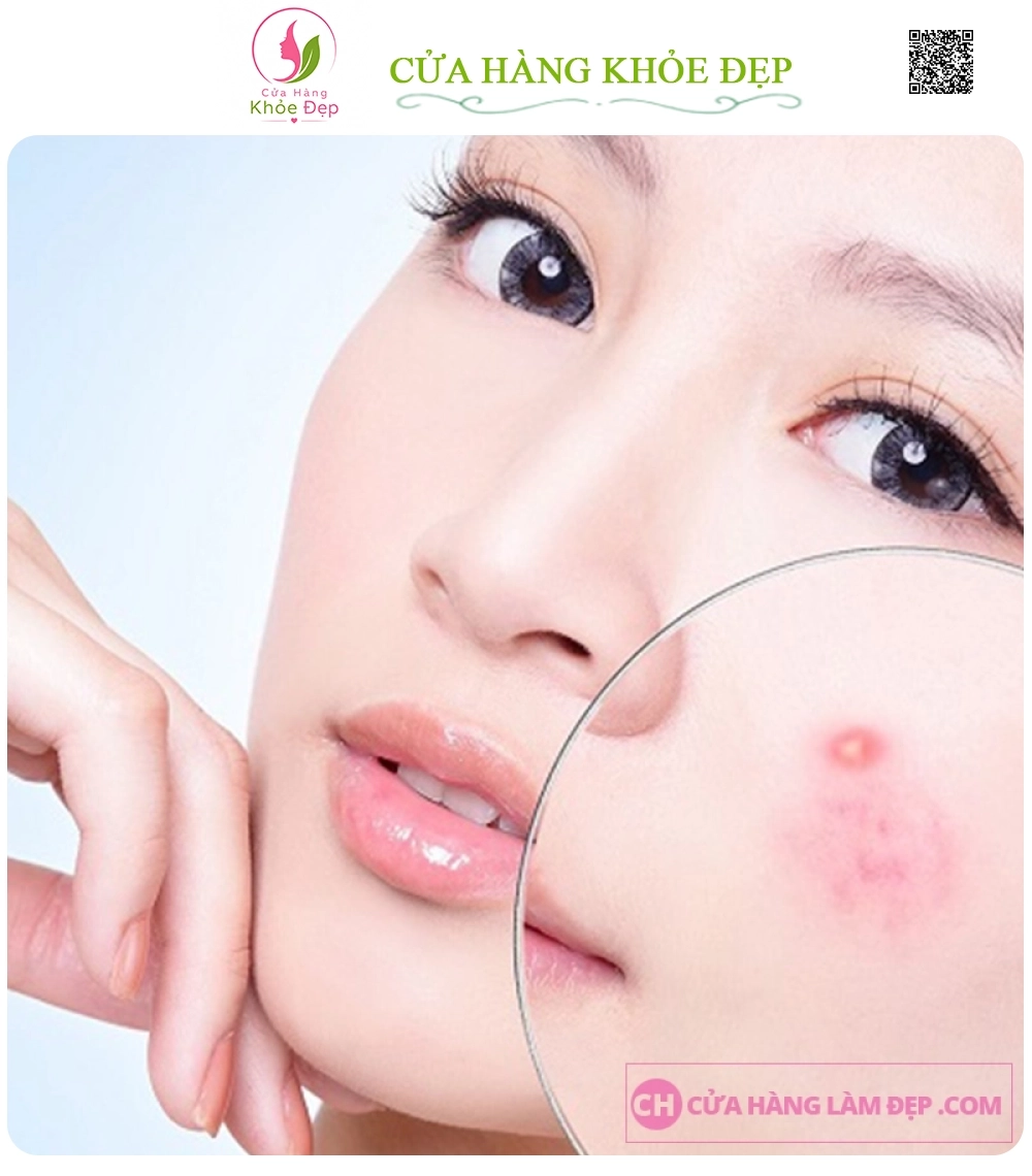 Liệu Trình Điều giảm Mụn Chuyên Sâu Bằng Công Nghệ Cao tại Meli Spa