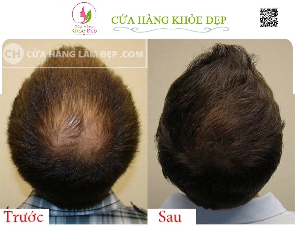 Tinh Chất Kích Thích Mọc Tóc Thảo Dược AROVICS Nhật Bản