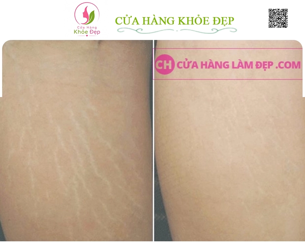 Tinh Chất Trị Rạn Nứt Da Toàn Thân Murad Cellulite Firm and Tone Serum