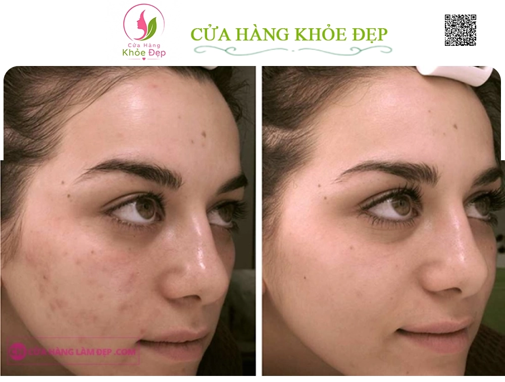 Kem Giảm Mụn Chuyên Biệt La Roche-Posay Effaclar Effaclar A.I.